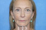 HR Plastic Surgery - Facelift patient after 2