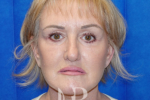 HR Plastic Surgery - Facelift patient after 5
