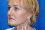 HR Plastic Surgery - Facelift patient after 6