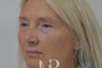 before a facelift picture