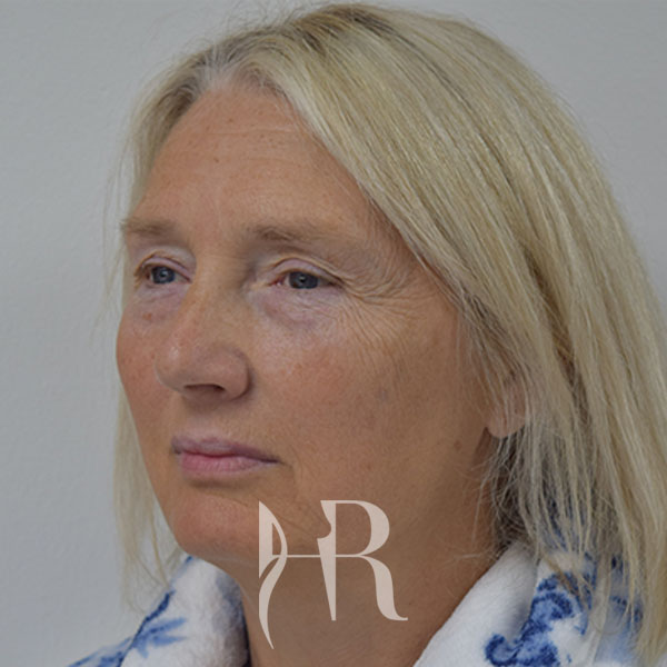 before a facelift picture