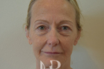 HR Plastic Surgery - Facelift patient before 2