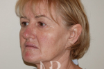 HR Plastic Surgery - Facelift patient before 6