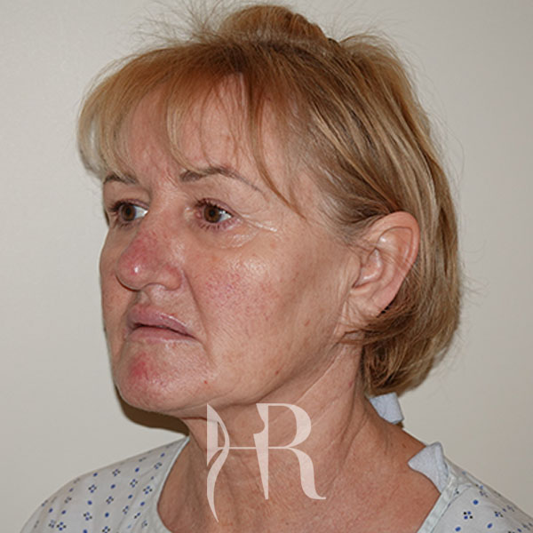 HR Plastic Surgery - Facelift patient before 6