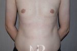 HR Plastic Surgery - Male Breast Reduction patient after 1