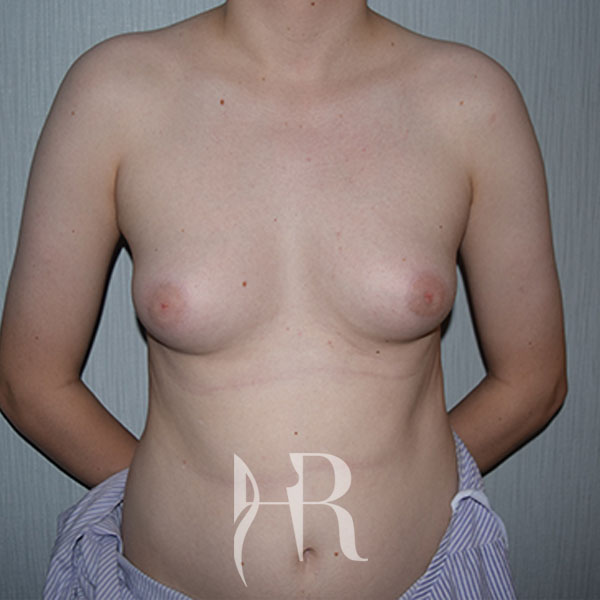 HR Plastic Surgery - Male Breast Reduction patient before 1