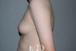 HR Plastic Surgery - Male Breast Reduction patient before 3