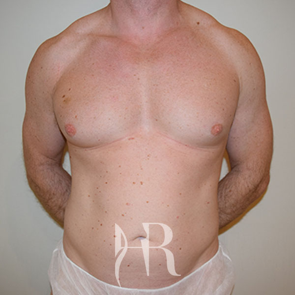 HR Plastic Surgery - Male Breast Reduction patient before 4