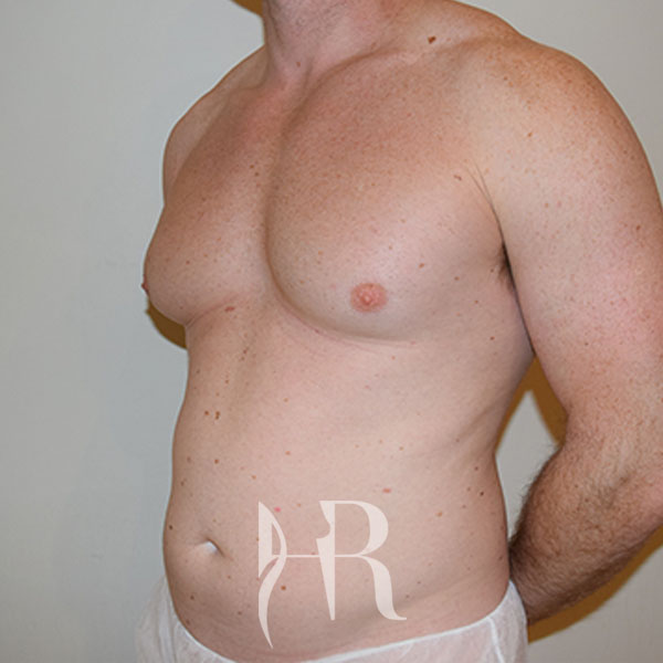 HR Plastic Surgery - Male Breast Reduction patient before 5