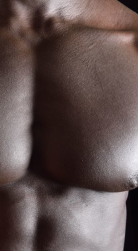 Male Gynecomastia surgery