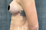 HR Plastic Surgery - Internal Mesh Bra Lift patient after 3