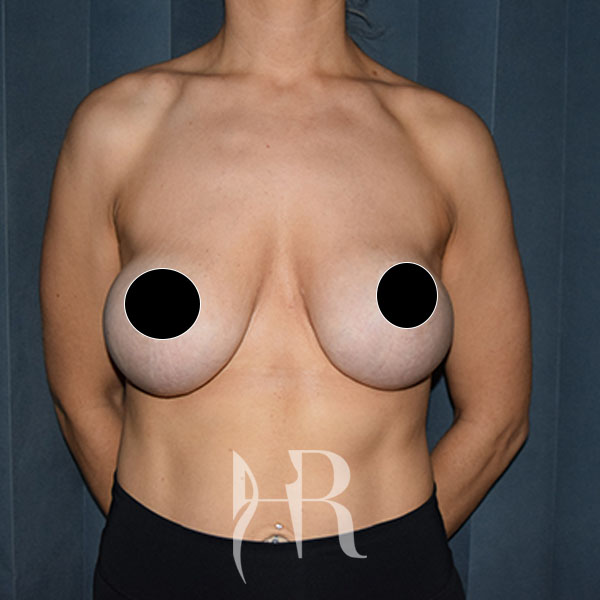 HR Plastic Surgery - Internal Mesh Bra Lift patient before 1