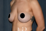 HR Plastic Surgery - Internal Mesh Bra Lift patient before 2