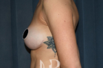 HR Plastic Surgery - Internal Mesh Bra Lift patient before 3