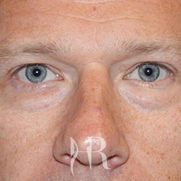 HR Plastic Surgery - Eyelid Surgery (Blepharoplasty) patient before 6