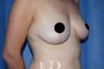HR Plastic Surgery - Breast Uplift patient after 4