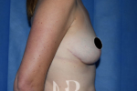 HR Plastic Surgery - Breast Uplift patient after 6