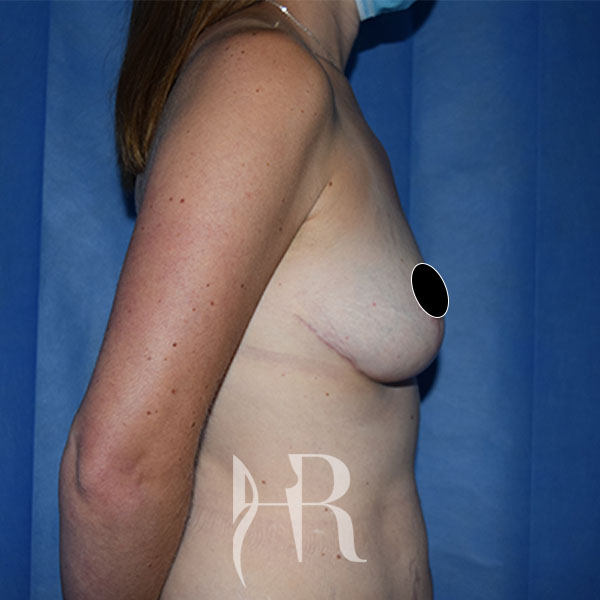 HR Plastic Surgery - Breast Uplift patient after 6