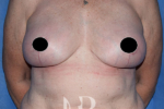 HR Plastic Surgery - Breast Uplift patient after 3