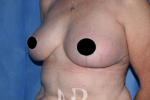 HR Plastic Surgery - Breast Uplift patient after 2