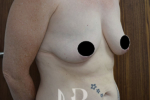 HR Plastic Surgery - Breast Uplift patient before 13