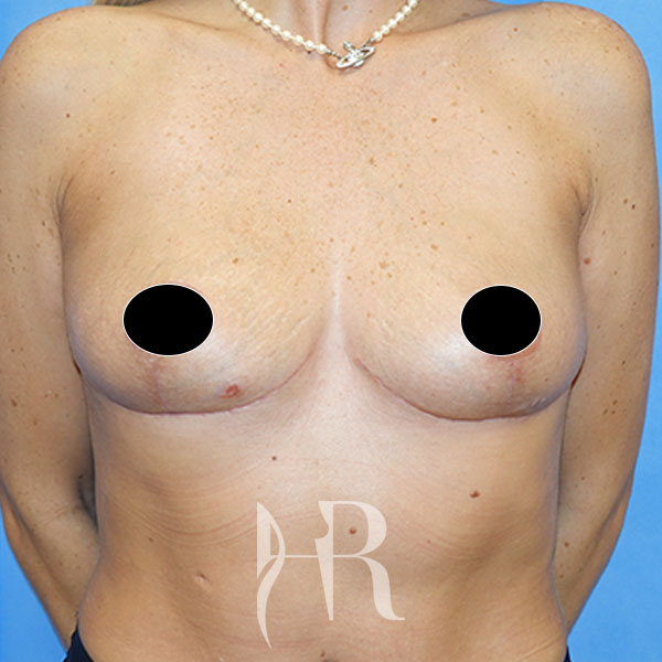 HR Plastic Surgery - Breast Uplift patient after 12