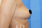 HR Plastic Surgery - Breast Uplift patient after 10