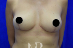 HR Plastic Surgery - Breast Uplift patient after 9
