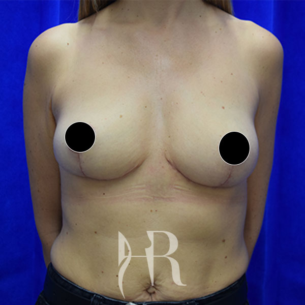 HR Plastic Surgery - Breast Uplift patient after 9