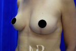 HR Plastic Surgery - Breast Uplift patient after 8