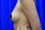 HR Plastic Surgery - Breast Uplift patient after 7