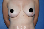 HR Plastic Surgery - Breast Uplift patient after 5