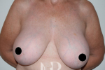 HR Plastic Surgery - Breast Uplift patient before 3