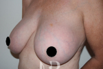 HR Plastic Surgery - Breast Uplift patient before 2
