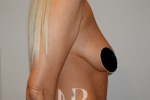 HR Plastic Surgery - Breast Uplift patient before 10