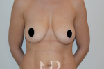 HR Plastic Surgery - Breast Uplift patient before 9
