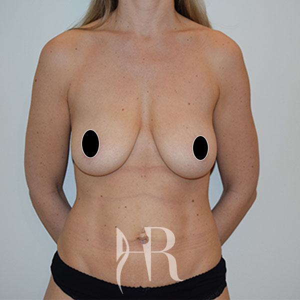 HR Plastic Surgery - Breast Uplift patient before 9