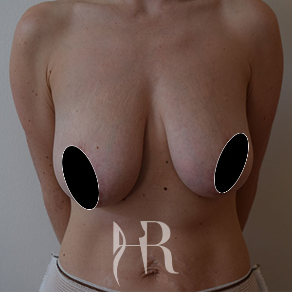 HR Plastic Surgery - Breast Uplift patient before 5