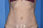 HR Plastic Surgery - Mini Tummy Tuck patient after 1