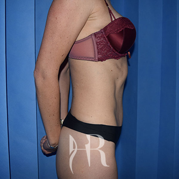 HR Plastic Surgery - Mini Tummy Tuck patient after 3