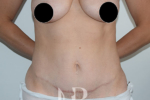 HR Plastic Surgery - Mini Tummy Tuck patient after 4
