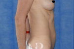 HR Plastic Surgery - Mini Tummy Tuck patient before 3