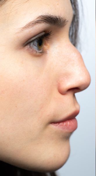 misshapen nose