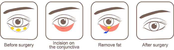 HR Plastic Surgery - How to Treat Lower Eyelid Bags