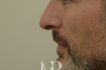 HR Plastic Surgery - Nose Reshaping (Rhinoplasty) patient after 1