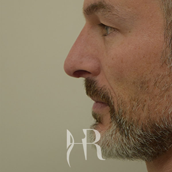 HR Plastic Surgery - Nose Reshaping (Rhinoplasty) patient after 1