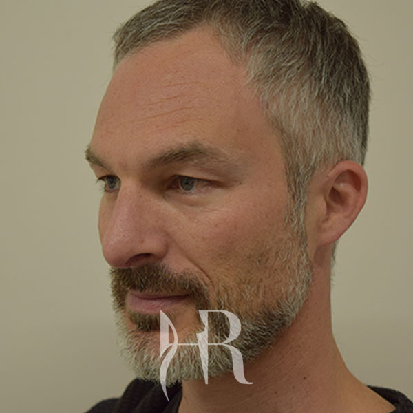 HR Plastic Surgery - Nose Reshaping (Rhinoplasty) patient after 2