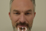 HR Plastic Surgery - Nose Reshaping (Rhinoplasty) patient after 3