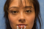 HR Plastic Surgery - Nose Reshaping (Rhinoplasty) patient after 5