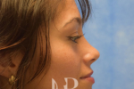 HR Plastic Surgery - Nose Reshaping (Rhinoplasty) patient after 6